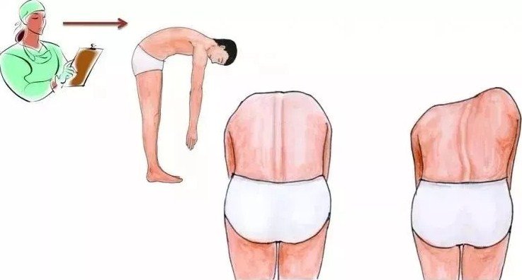 脊柱側(cè)彎早發(fā)現(xiàn)，早治療