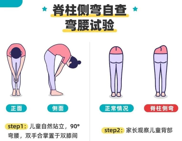 脊柱側彎與自查