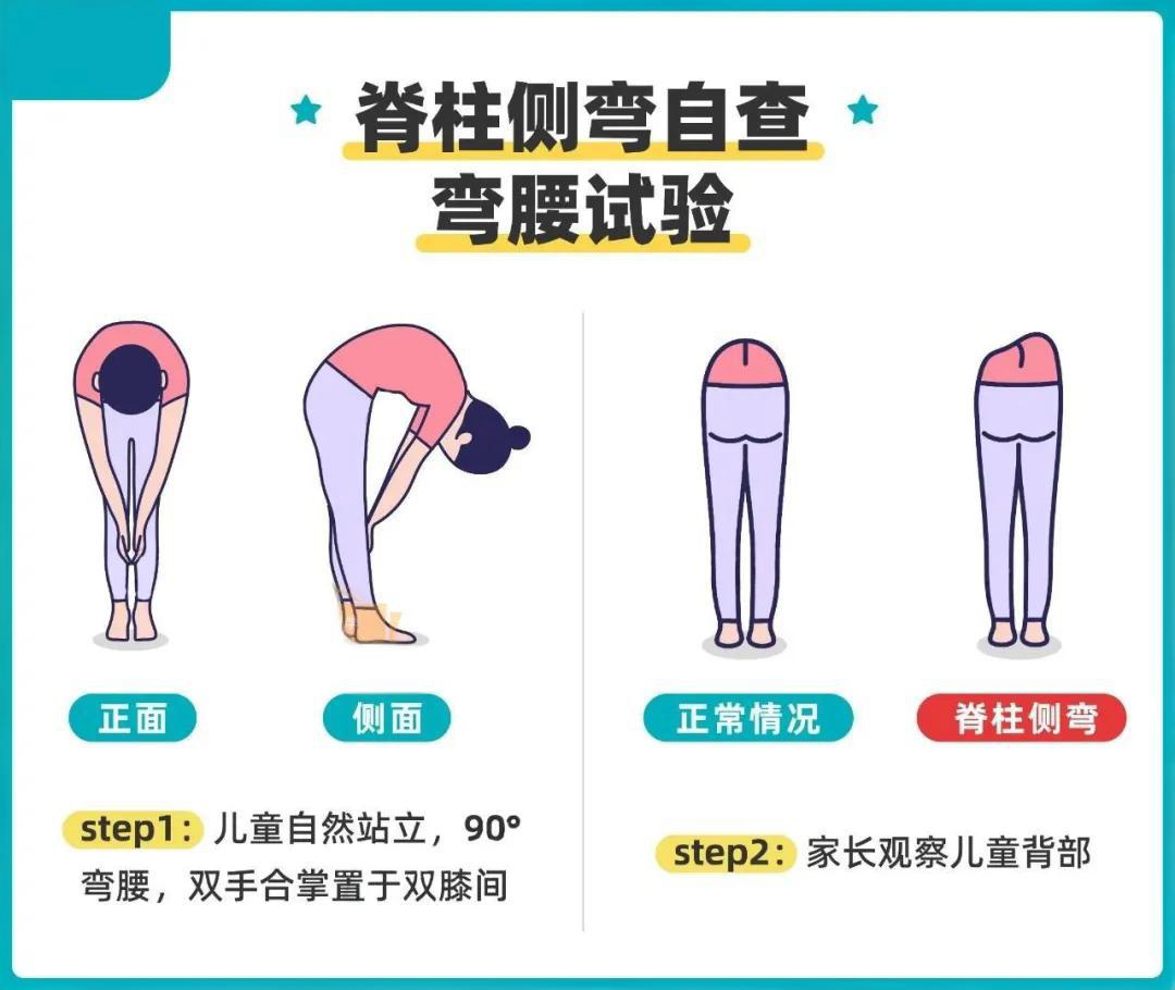 脊柱側(cè)彎與家庭自查