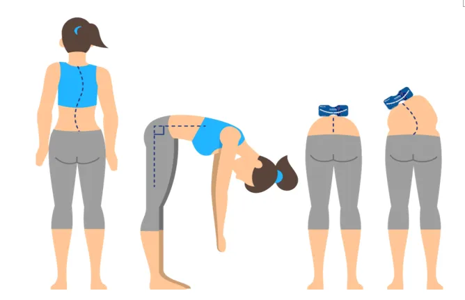 脊柱側(cè)彎支具穿戴3個(gè)月要及時(shí)復(fù)查