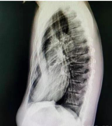 漏斗胸怎么矯正？