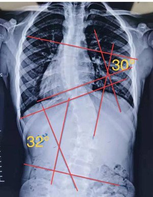 睡姿對脊柱側(cè)彎患者的影響