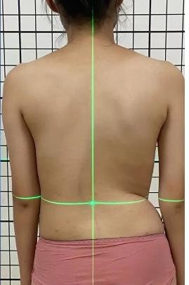 睡姿對脊柱側(cè)彎患者的影響