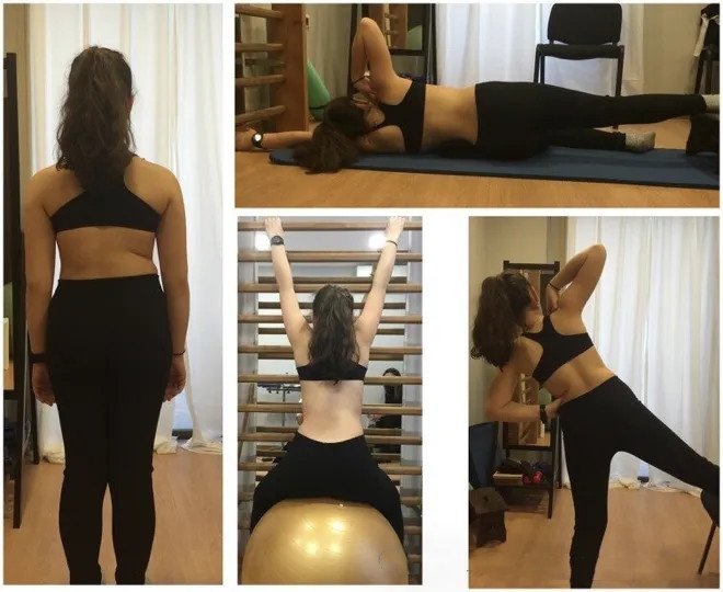 成人脊柱側(cè)彎怎么辦？